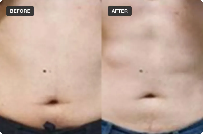 Pelvic Floor EMS treatment area before and after, manufacturer clinical photo