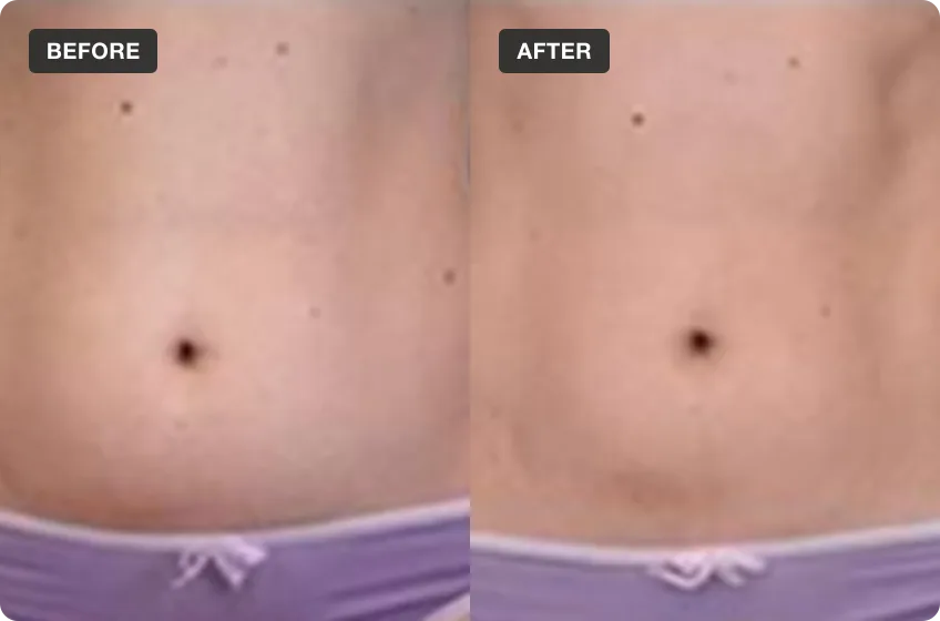 Pelvic Floor EMS treatment area before and after, manufacturer clinical photo