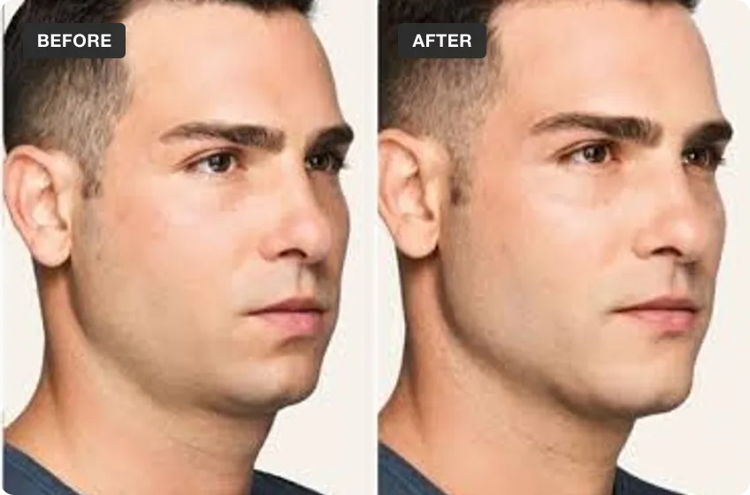 Dermal Filler treatment area before and after, manufacturer clinical photo