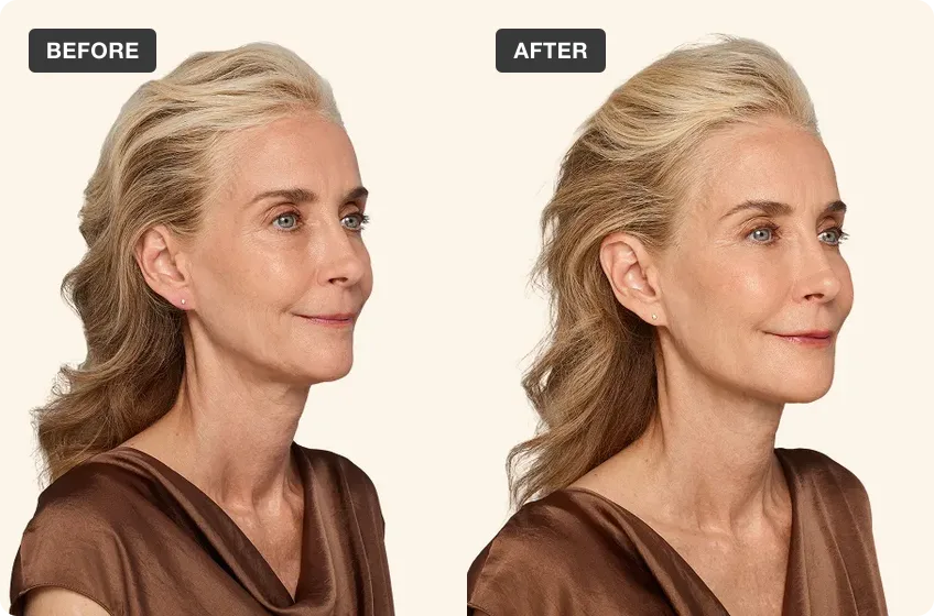 Dermal Filler treatment area before and after, manufacturer clinical photo