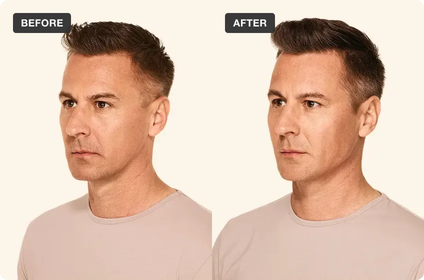 Dermal Filler treatment area before and after, manufacturer clinical photo