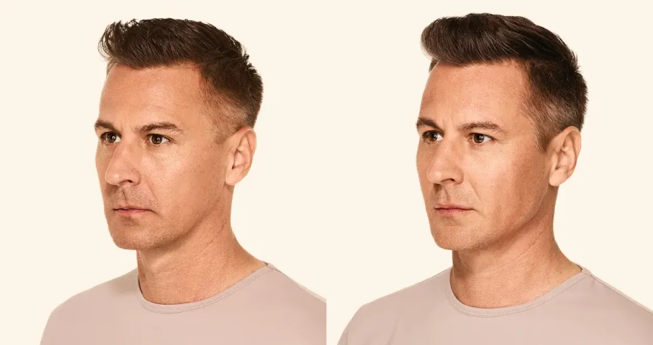 Dermal Filler treatment area before and after