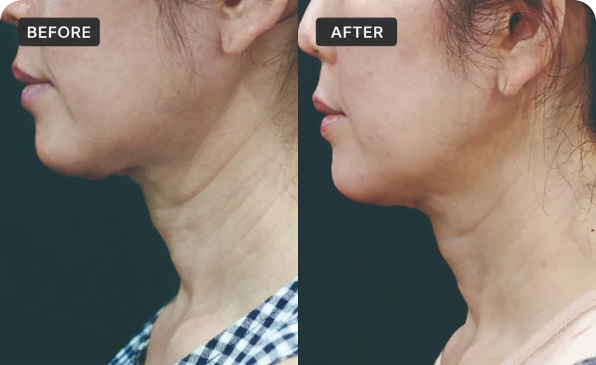 HIFU treatment area before and after a Prime Clinics research program