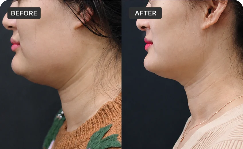 HIFU treatment area before and after a Prime Clinics research program