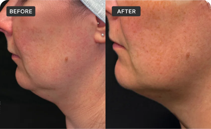 HIFU treatment area before and after a Prime Clinics research program