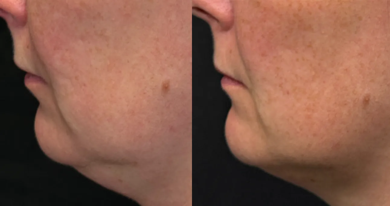 HIFU treatment area before and after