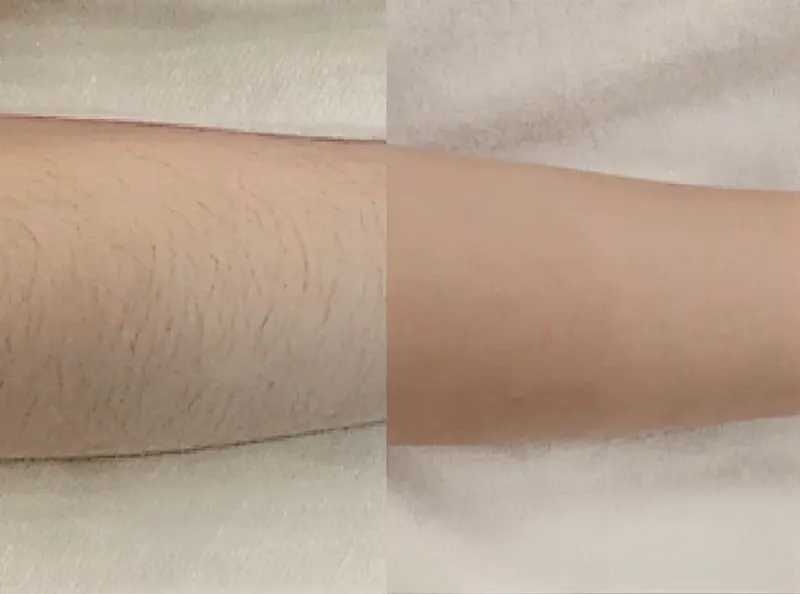 Laser Hair Removal
