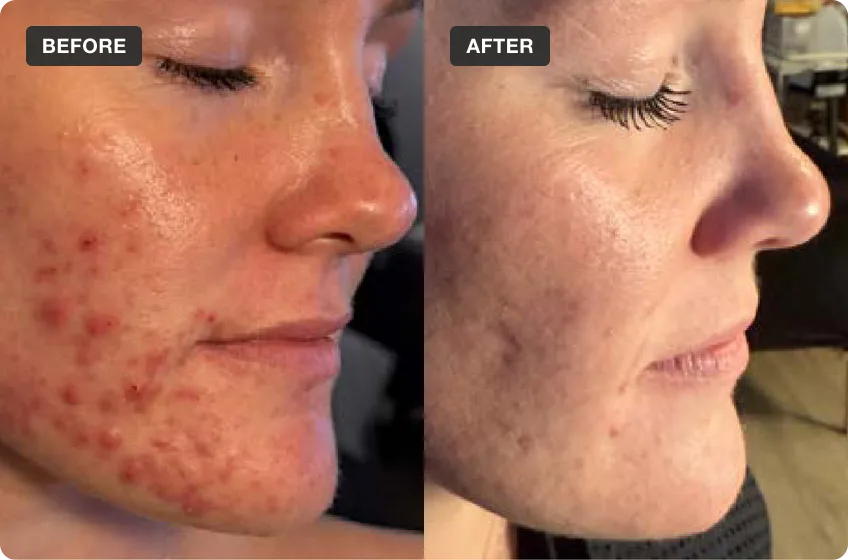 Salicylic Peels treatment area before and after, manufacturer clinical photo