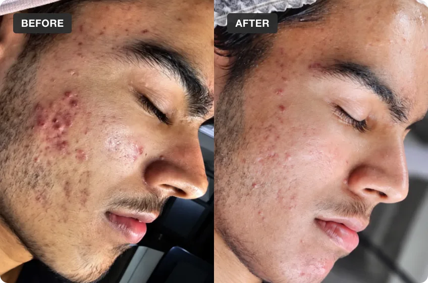 Salicylic Peels treatment area before and after