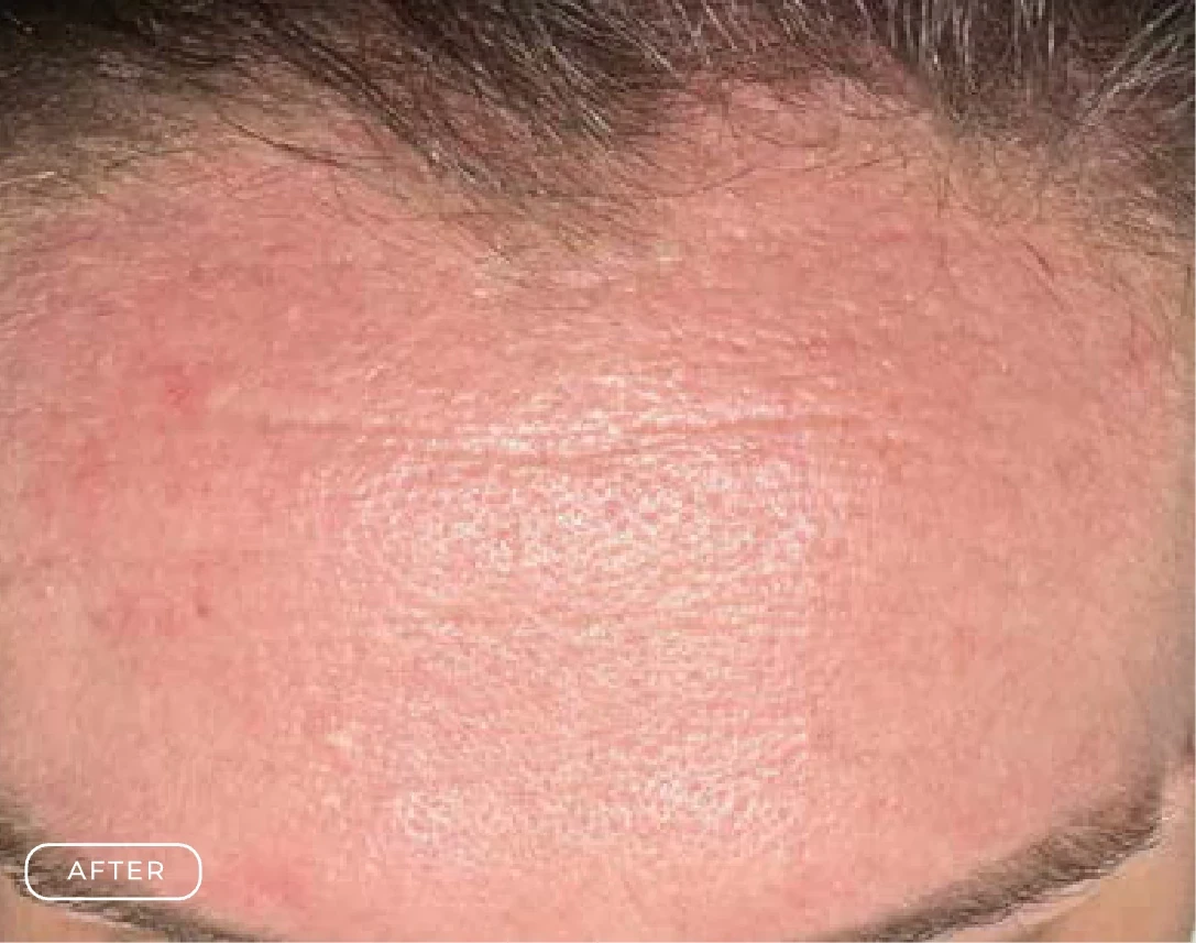 After Radiance Enzyme Skin Treatment