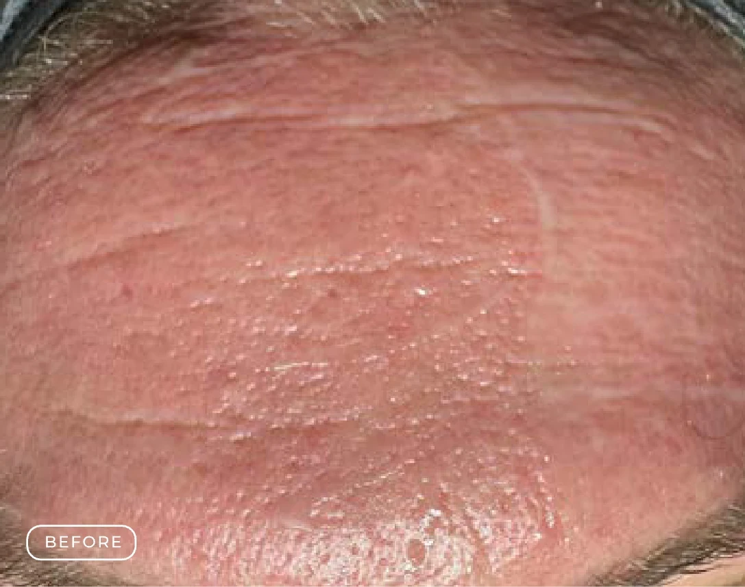 Before Radiance Enzyme Skin Treatment