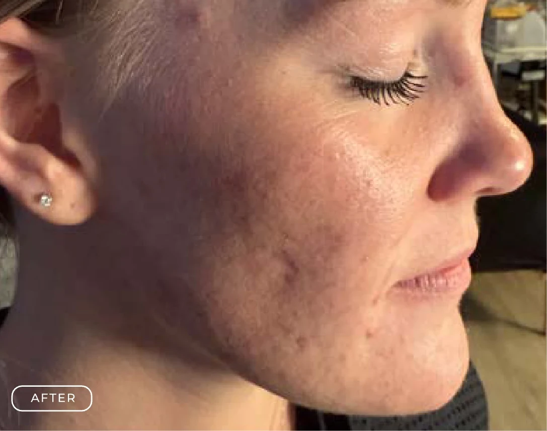 After Refine Skin Resurfacing Treatment