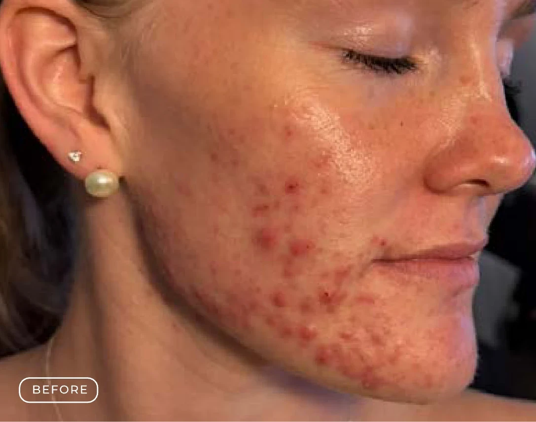 Before Refine Skin Resurfacing Treatment