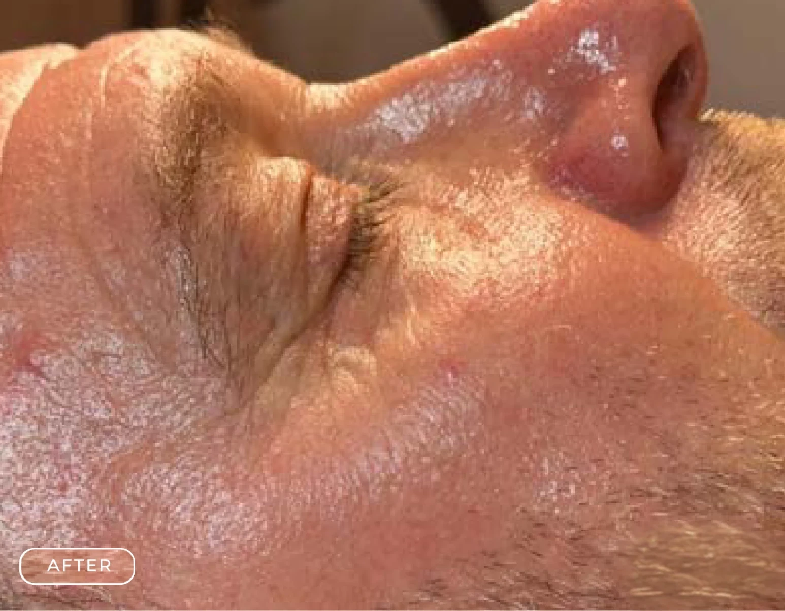 After Refresh Skin Rejuvenation Treatment