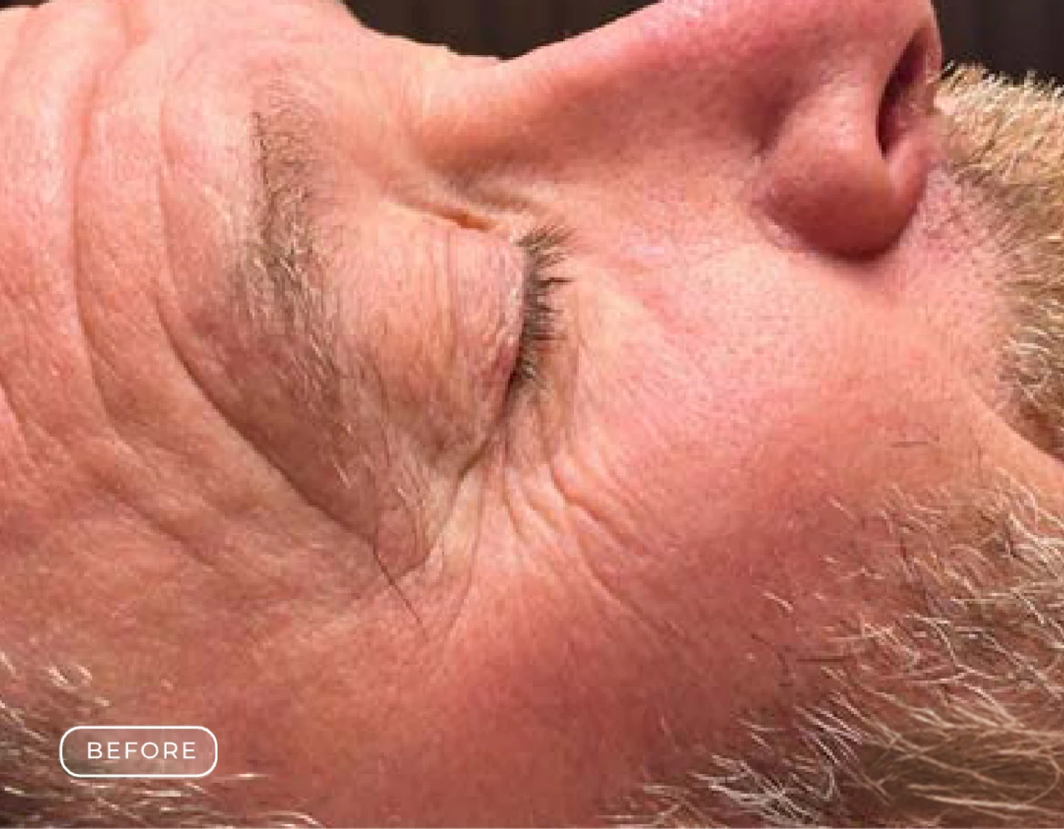 Before Refresh Skin Rejuvenation Treatment