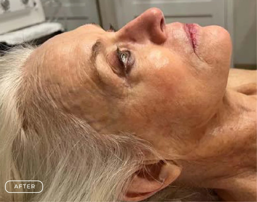 After — Client's skin before and after a Renew Skin Restoration Treatment