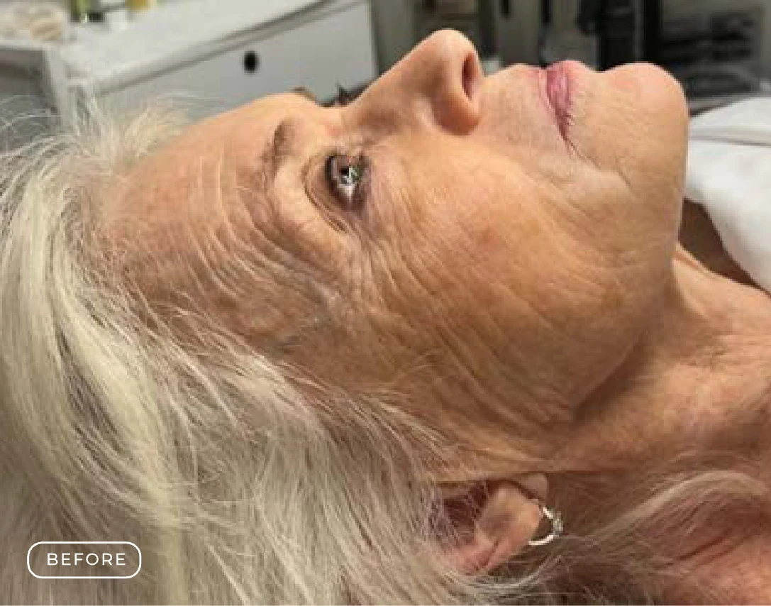 Before — Client's skin before and after a Renew Skin Restoration Treatment