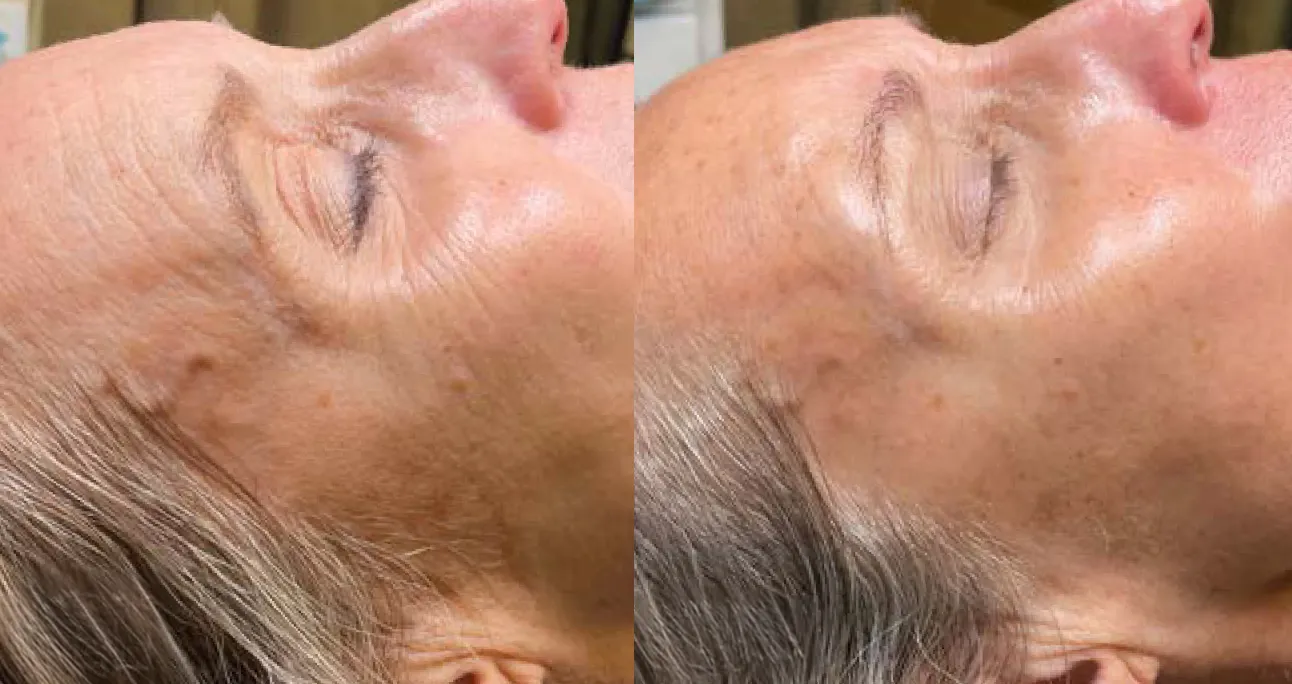 Salicylic Peels treatment area before and after