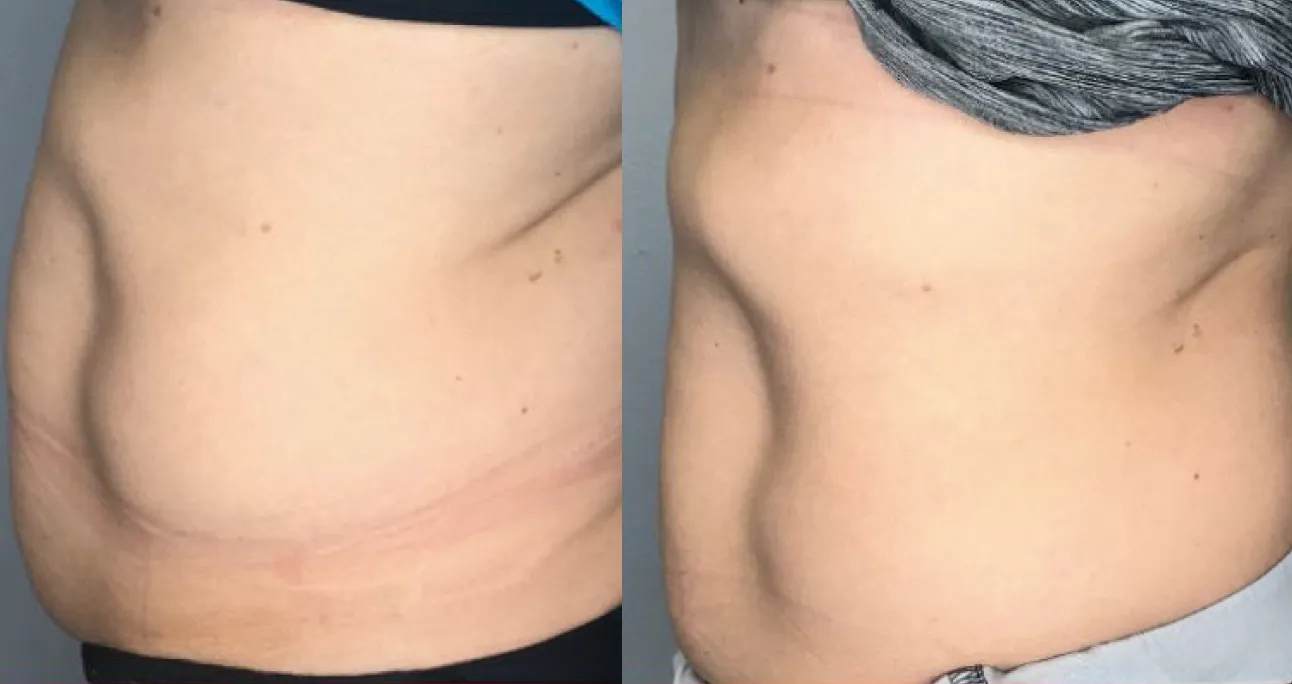 Pelvic Floor EMS treatment area before and after