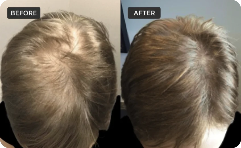 PRP treatment area before and after a Prime Clinics research program