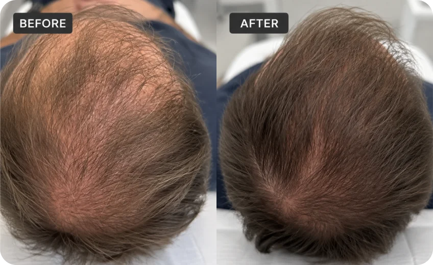 PRP treatment area before and after a Prime Clinics research program