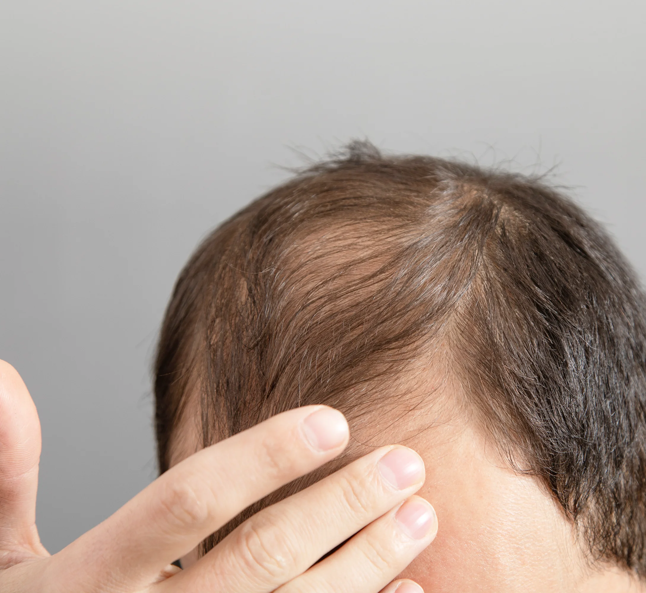 PRP hair restoration before and after results at Prime Clinics