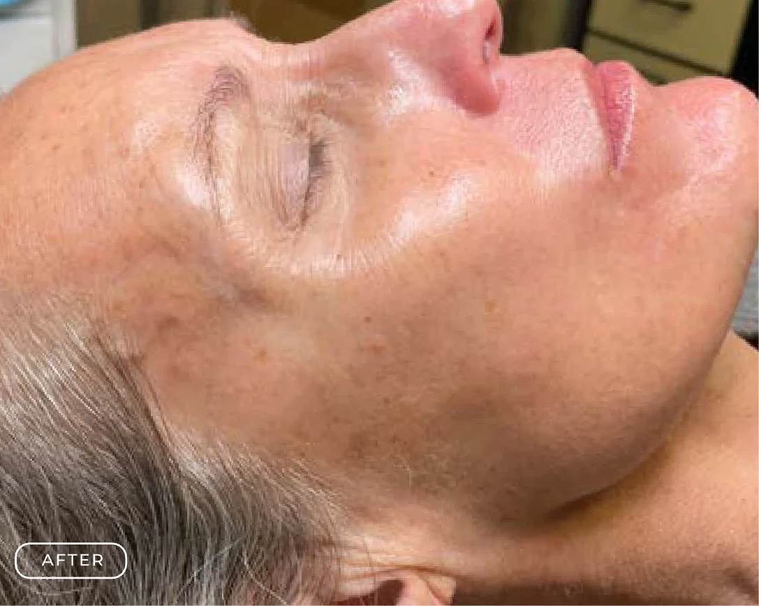 After — Client's skin before and after a Prime Clinics peel treatment