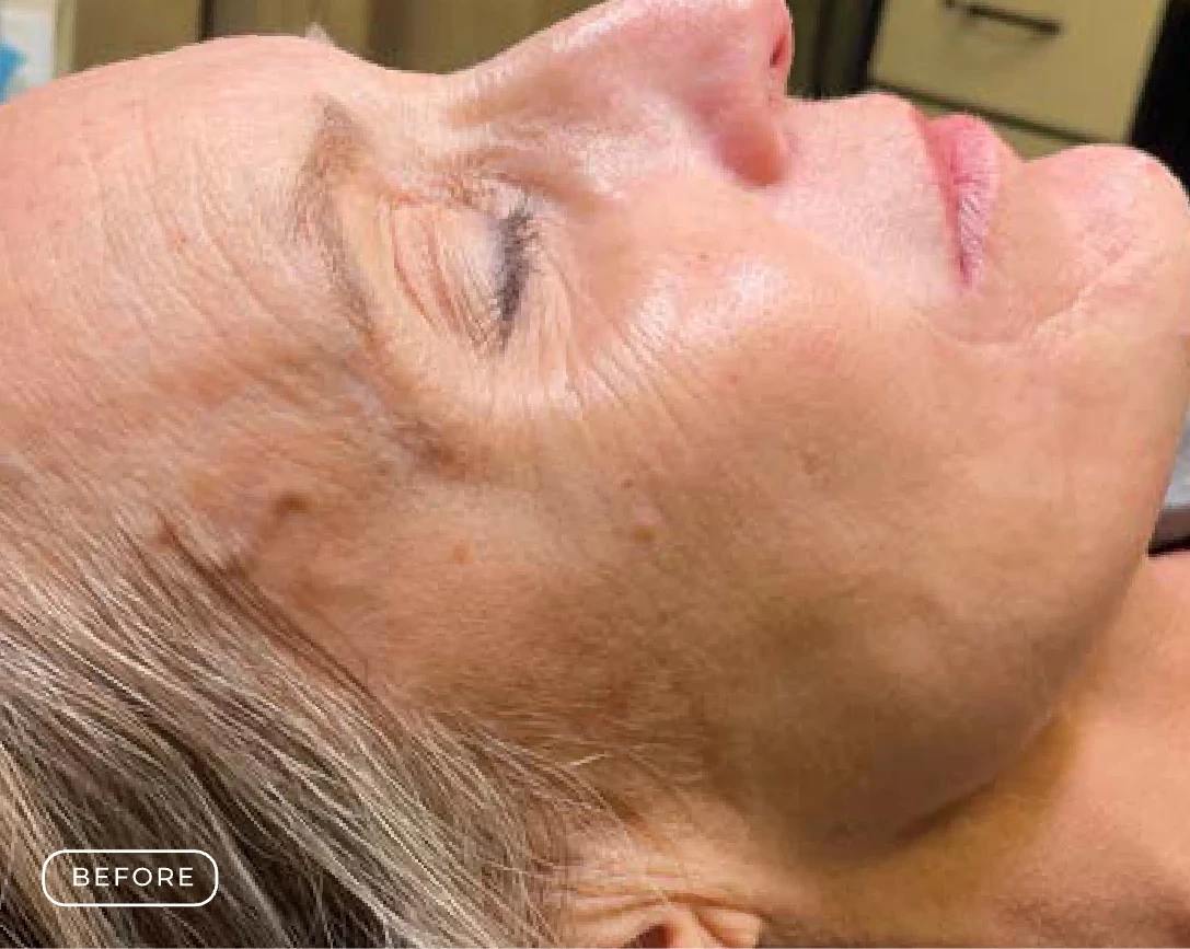 Before — Client's skin before and after a Prime Clinics peel treatment