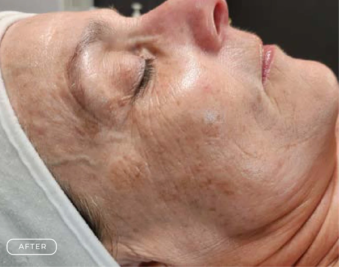 After — Client's skin before and after a Prime Clinics peel treatment