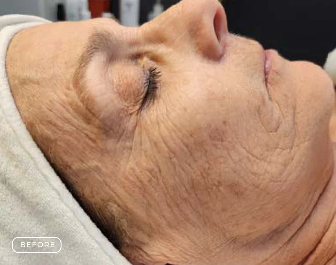 Before — Client's skin before and after a Prime Clinics peel treatment