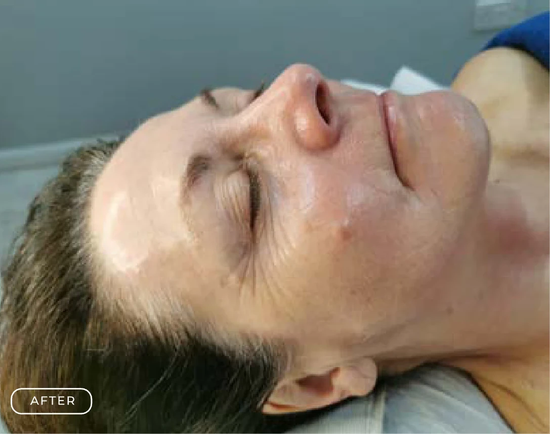 After — Client's skin before and after a Prime Clinics peel treatment