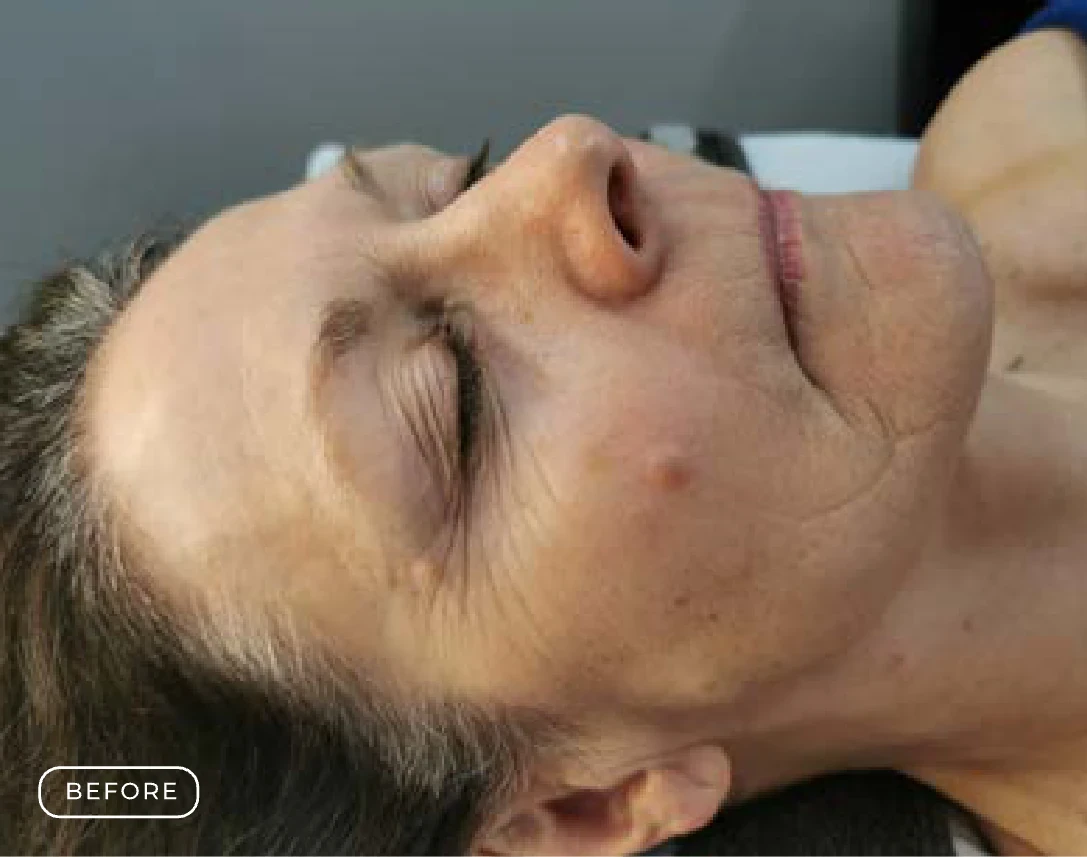 Before — Client's skin before and after a Prime Clinics peel treatment