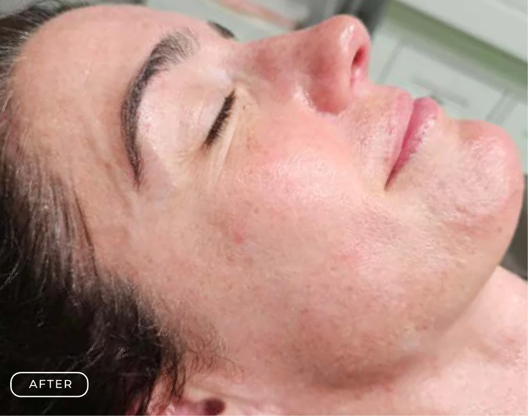 After — Client's skin before and after a Prime Clinics peel treatment
