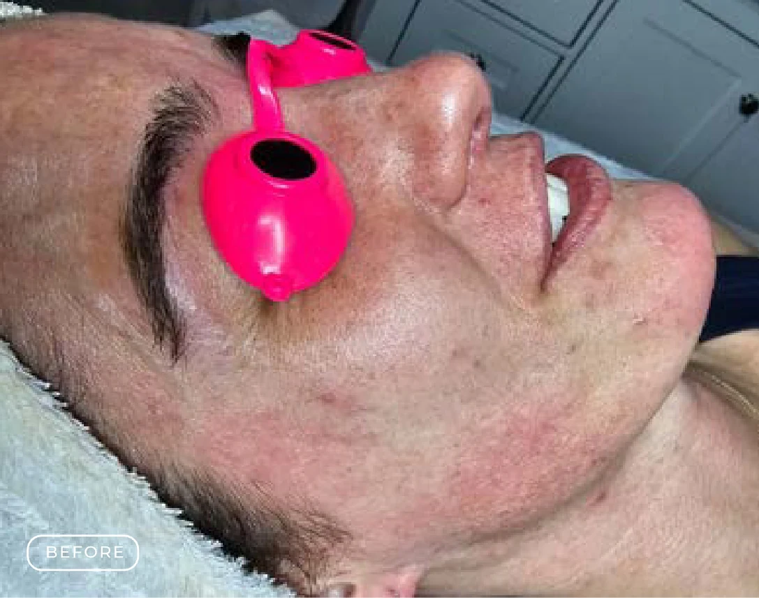 Before — Client's skin before and after a Prime Clinics peel treatment