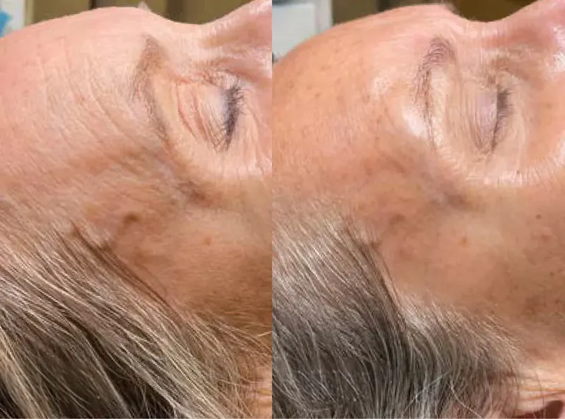 Chemical Peels