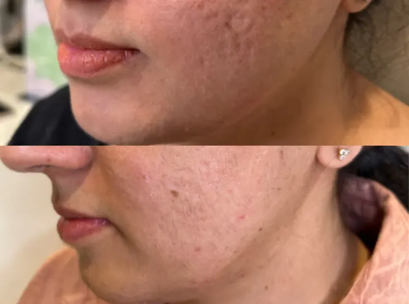 RF Microneedling