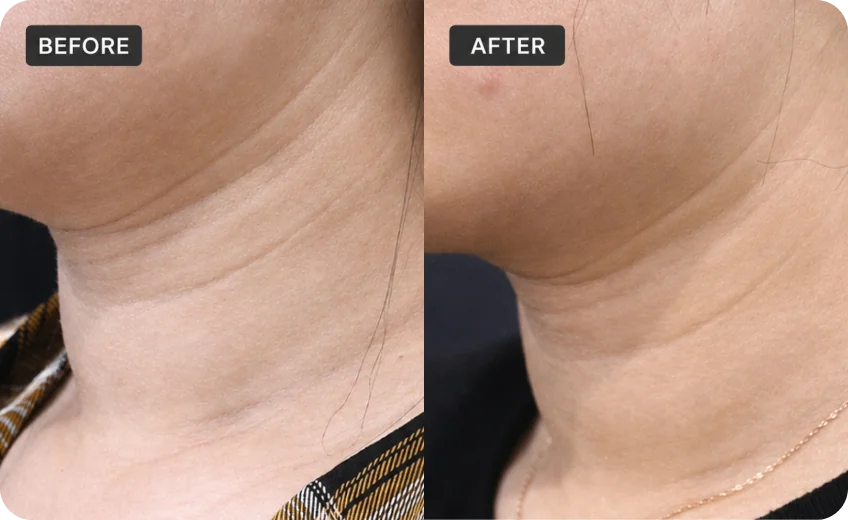 RFM treatment area before and after a Prime Clinics research program
