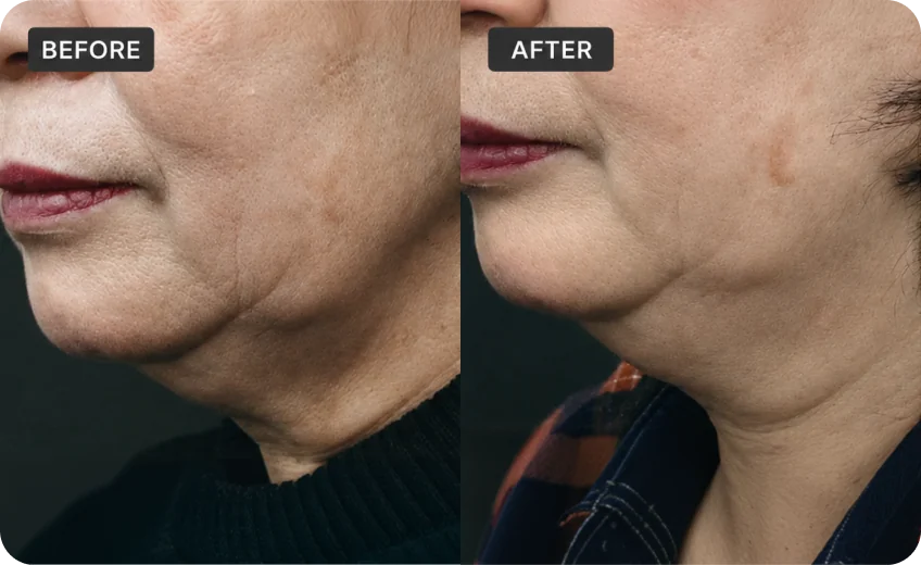 RFM treatment area before and after a Prime Clinics research program