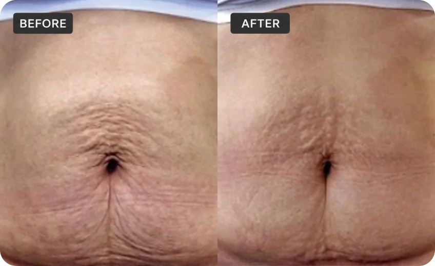RFM treatment area before and after a Prime Clinics research program
