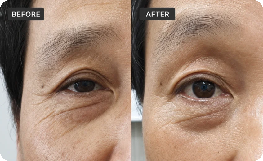 RFM treatment area before and after a Prime Clinics research program