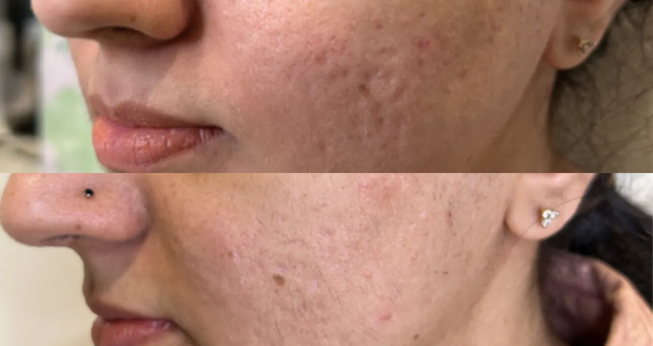 RF Microneedling treatment area before and after